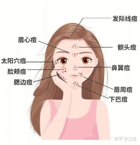 女生 痘痘|脸部各个区域长痘说明什么？